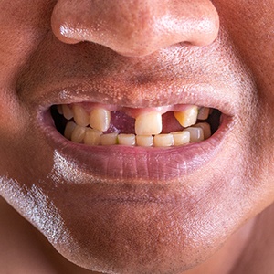 Patient with missing teeth in Las Vegas