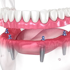 Implant dentures in Las Vegas