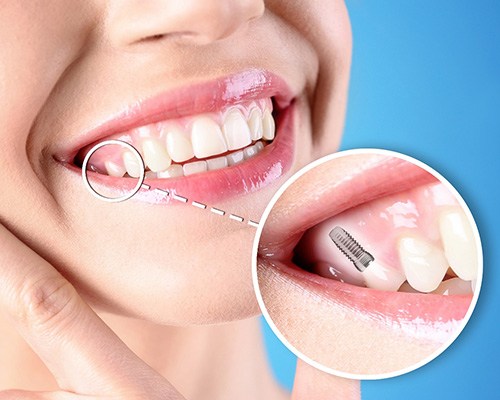 Nose-to-neck view of woman smiling with one tooth indicated as an implant