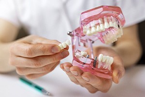 a dentist holding a dental implant model