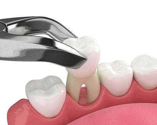 Illustration of a tooth extraction