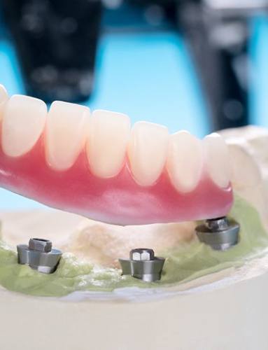 Denture resting on top of dental implants that are in a wax model