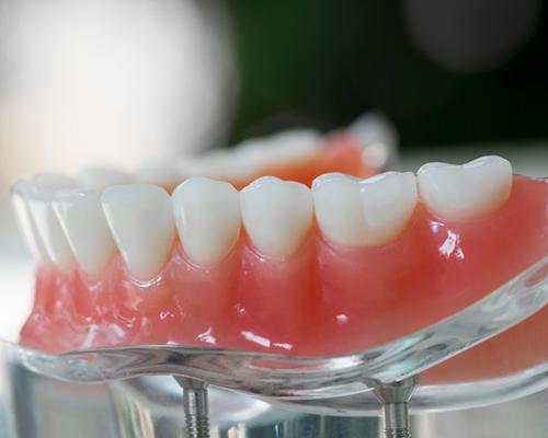 Model lower denture resting on a transparent stand with dental implants