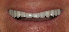 After Smile
