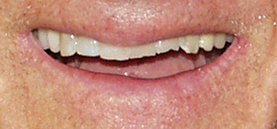 Before Smile
