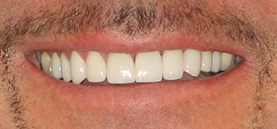 After Smile