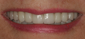 After Smile