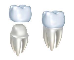 Choose same-day crowns in Summerlin for convenient dental care.