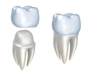 Choose same-day crowns in Summerlin for convenient dental care.