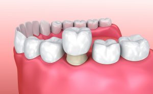 Graphic of dental crowns in a jaw