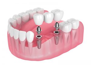 dental bridge 3d illustration 